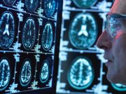 Epilepsia en Colombia: una condición neurológica frecuente que requiere mayor visibilidad y atención oportuna